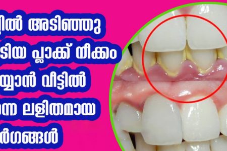 പല്ലിൽ അടിഞ്ഞു കൂടിയ പ്ലാക്ക് നീക്കം ചെയ്യാൻ വീട്ടിൽ തന്നെ ചെയ്യാവുന്ന ലളിതമായ മാർഗങ്ങൾ; അറിയാതെ പോകരുതേ.. | Teeth plaque removal