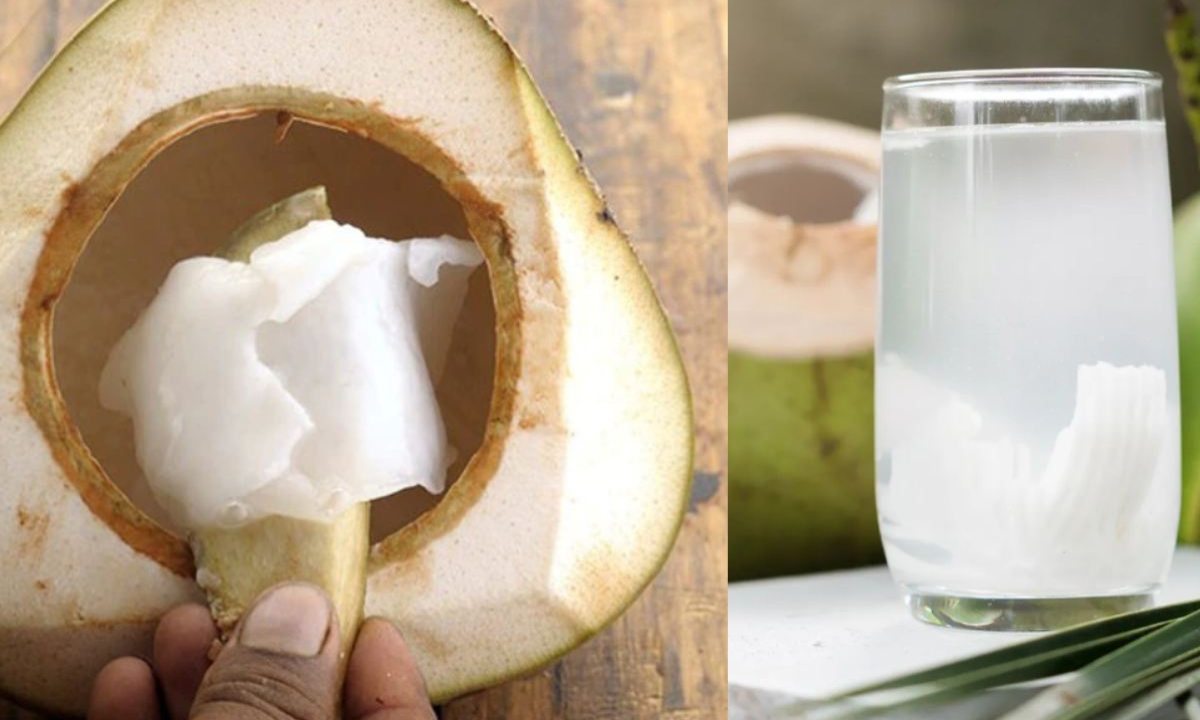 How to Remove Kidney Stones
