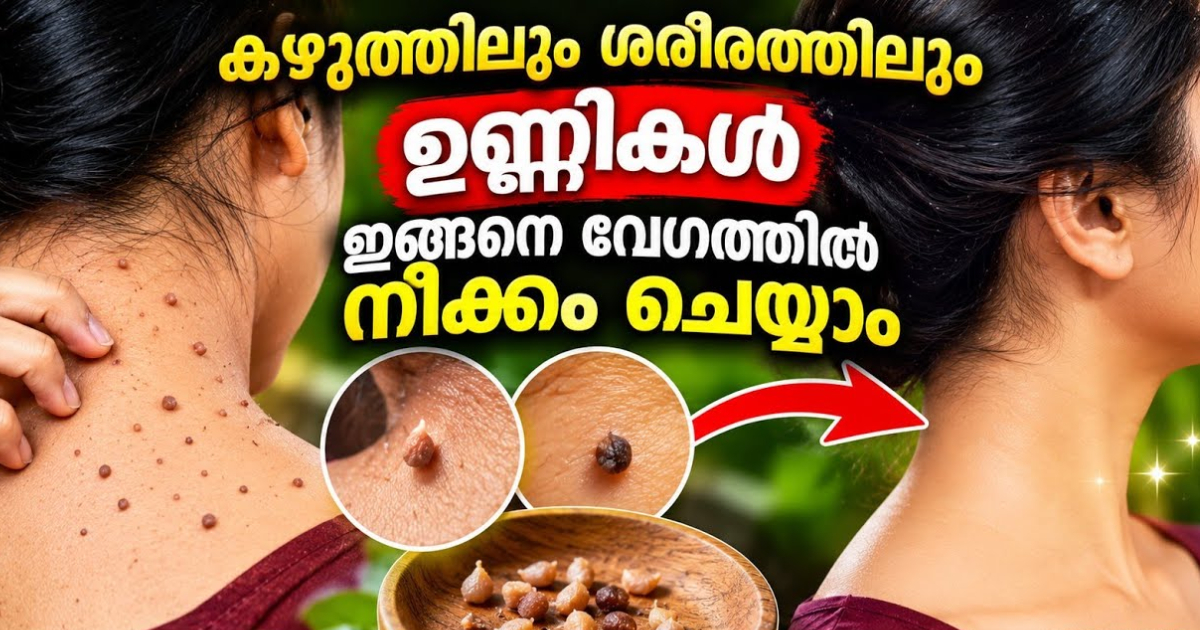 Skin Tag Removal